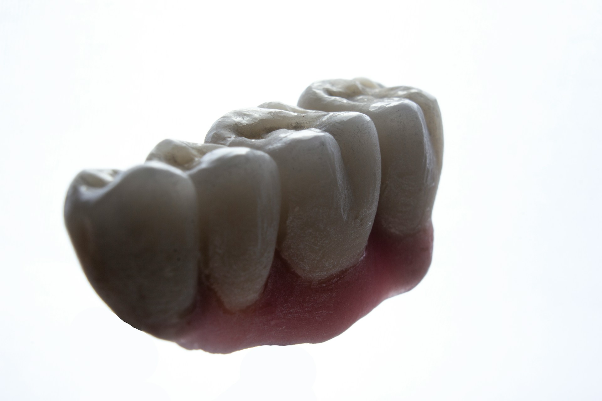 Amalgam vs White Fillings: Why the Debate Is Already Over