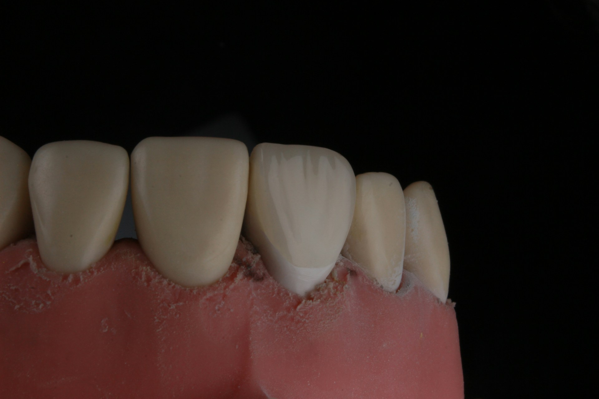 Black Triangles Between Teeth: Causes and Treatment Options