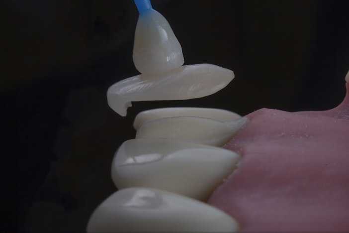 Dental Veneer Problems: What Can Go Wrong, What's Normal, and What to Do