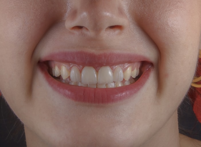 Gap Between Front Teeth: Treatment Options, Costs, and What Works Best
