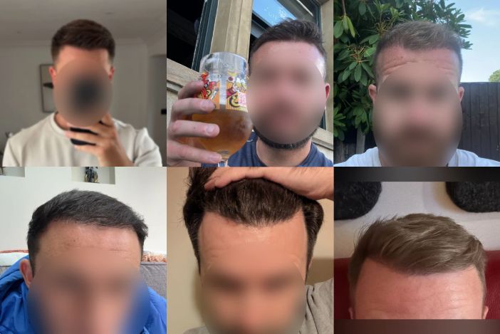 Hair Transplant Costs: Turkey vs UK (The Real Numbers)