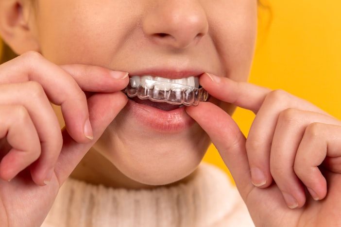 How Long Does Invisalign Take? The 2026 Timeline (And What Really Decides It)