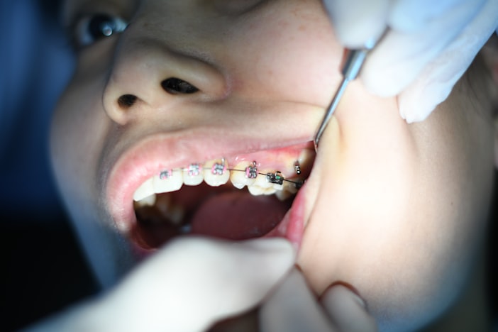 Pericoronitis: The Wisdom Tooth Gum Infection That Keeps Coming Back