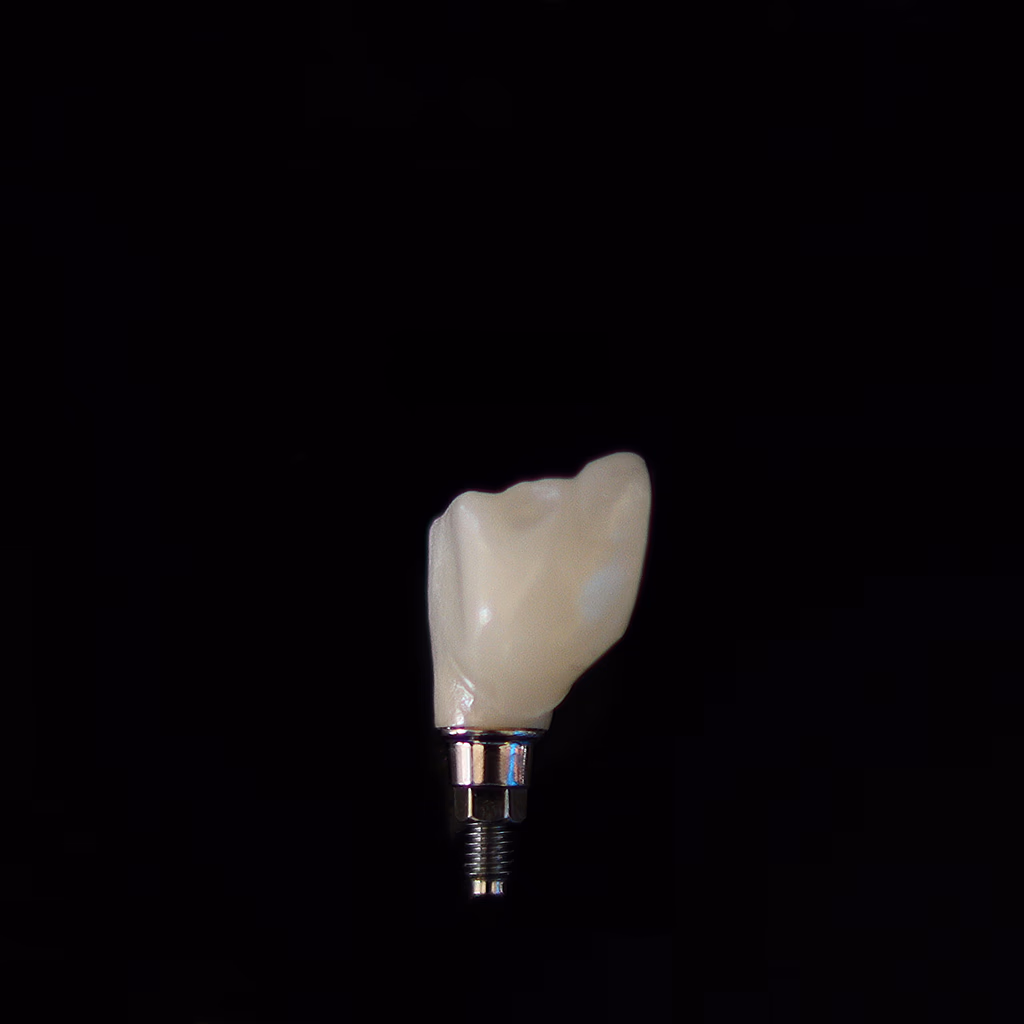Single Tooth Implant Costs for 2026 (What You'll Actually Pay)