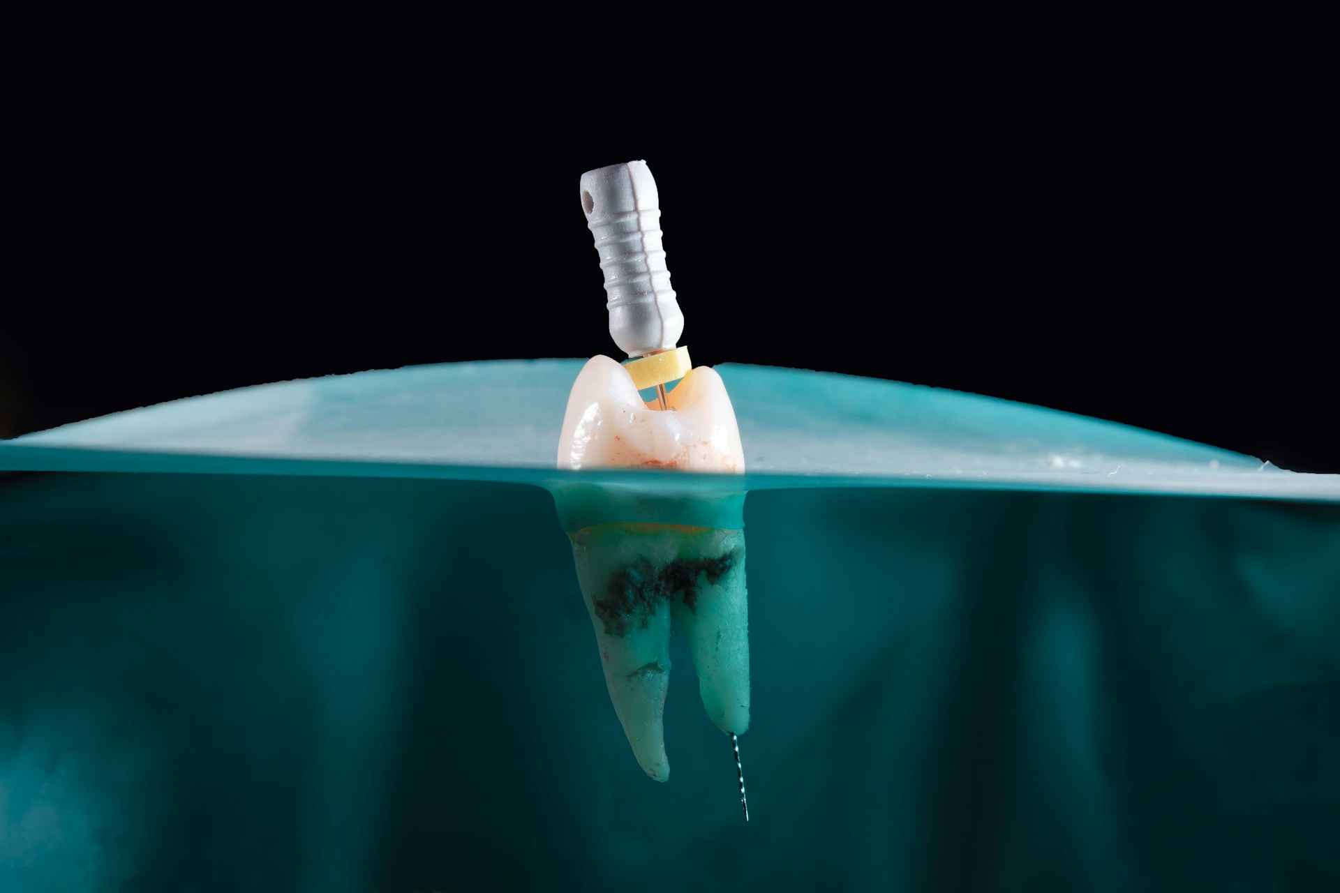 What Is Root Canal Treatment? The Procedure Explained