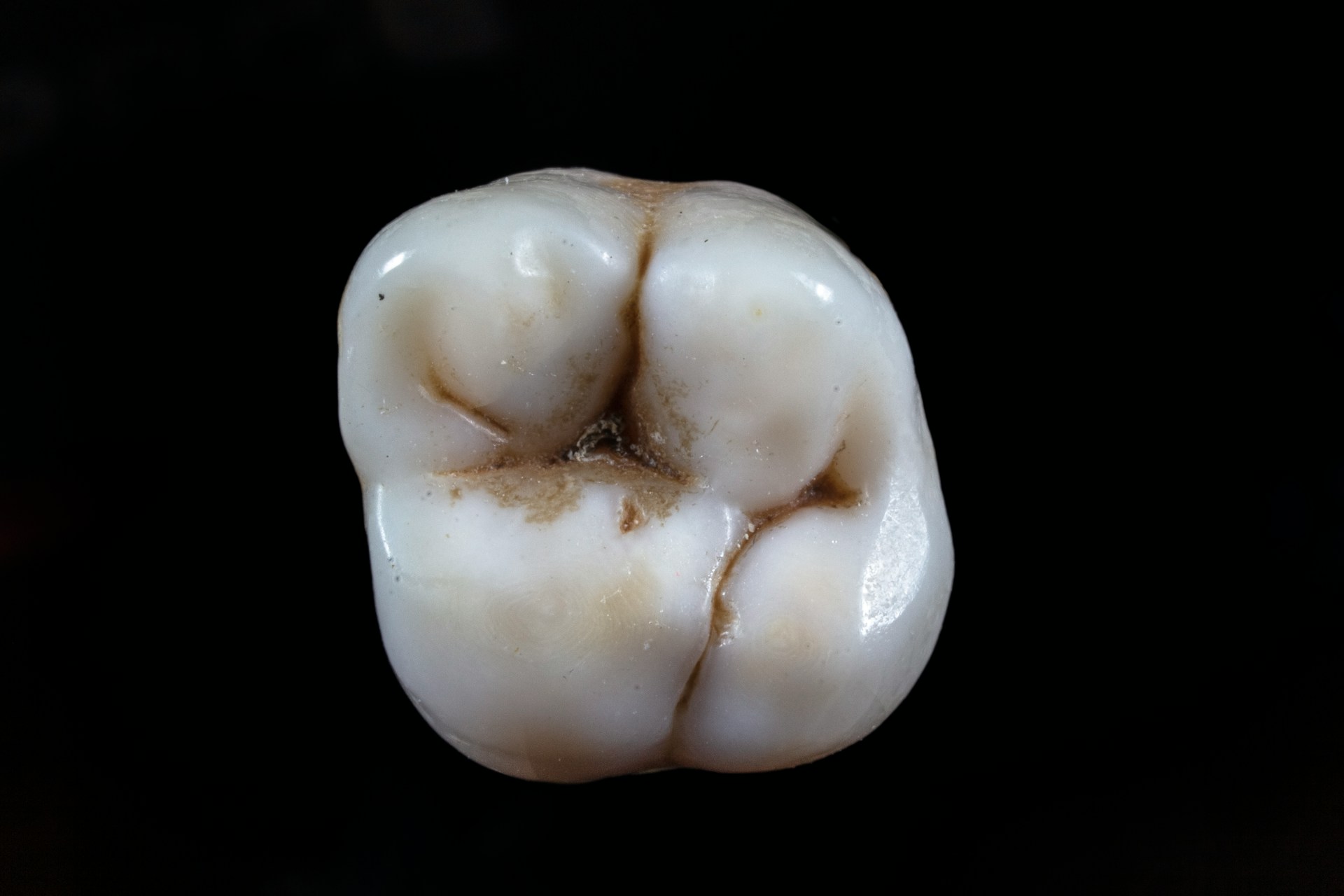 White Filling Costs UK: What You'll Actually Pay