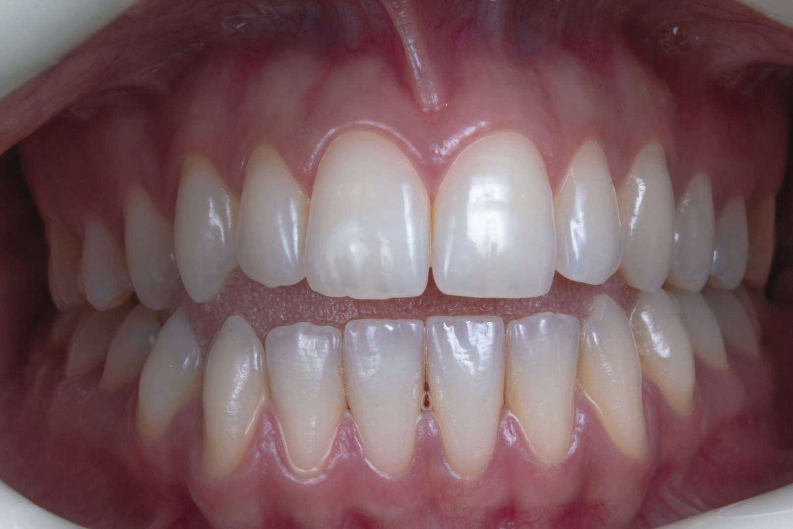 Why Do I Have a White Spot on My Tooth? Causes and Fixes