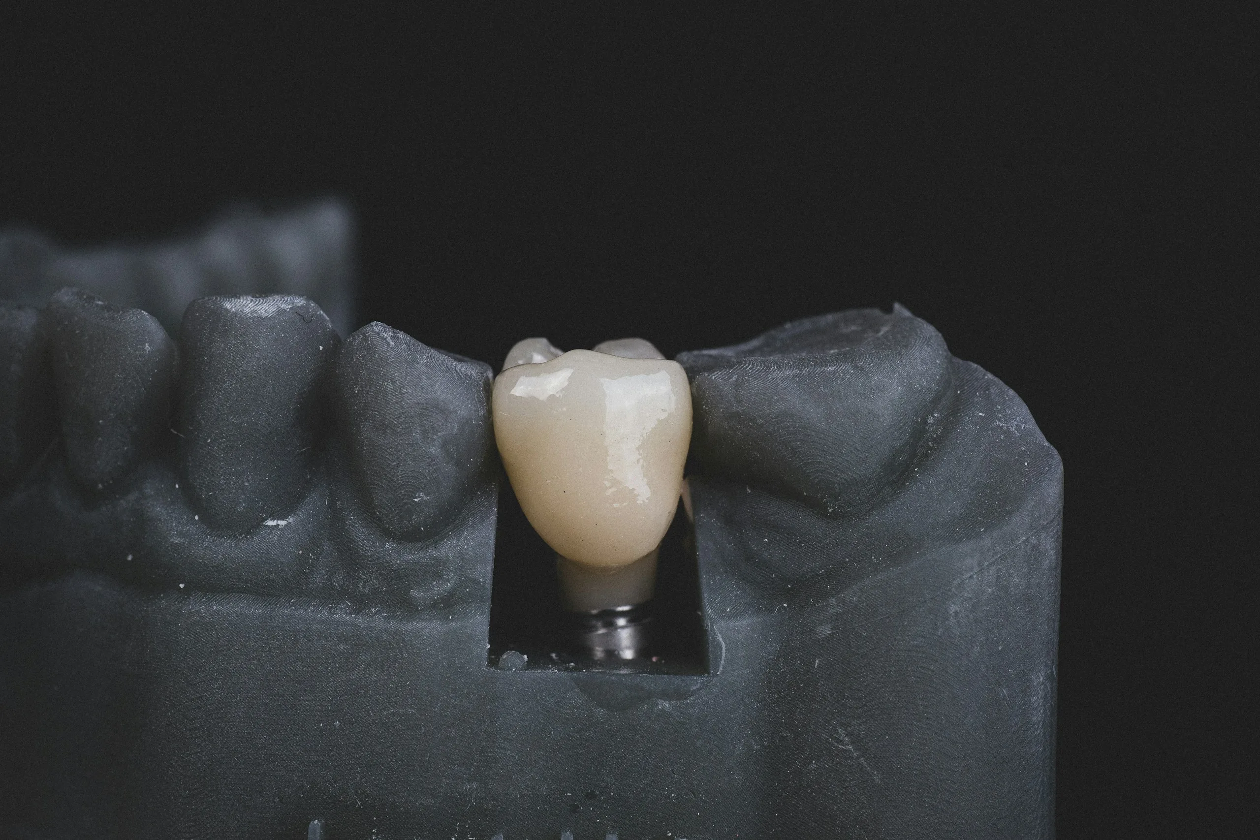 Dental crown at UrgentCare Dental