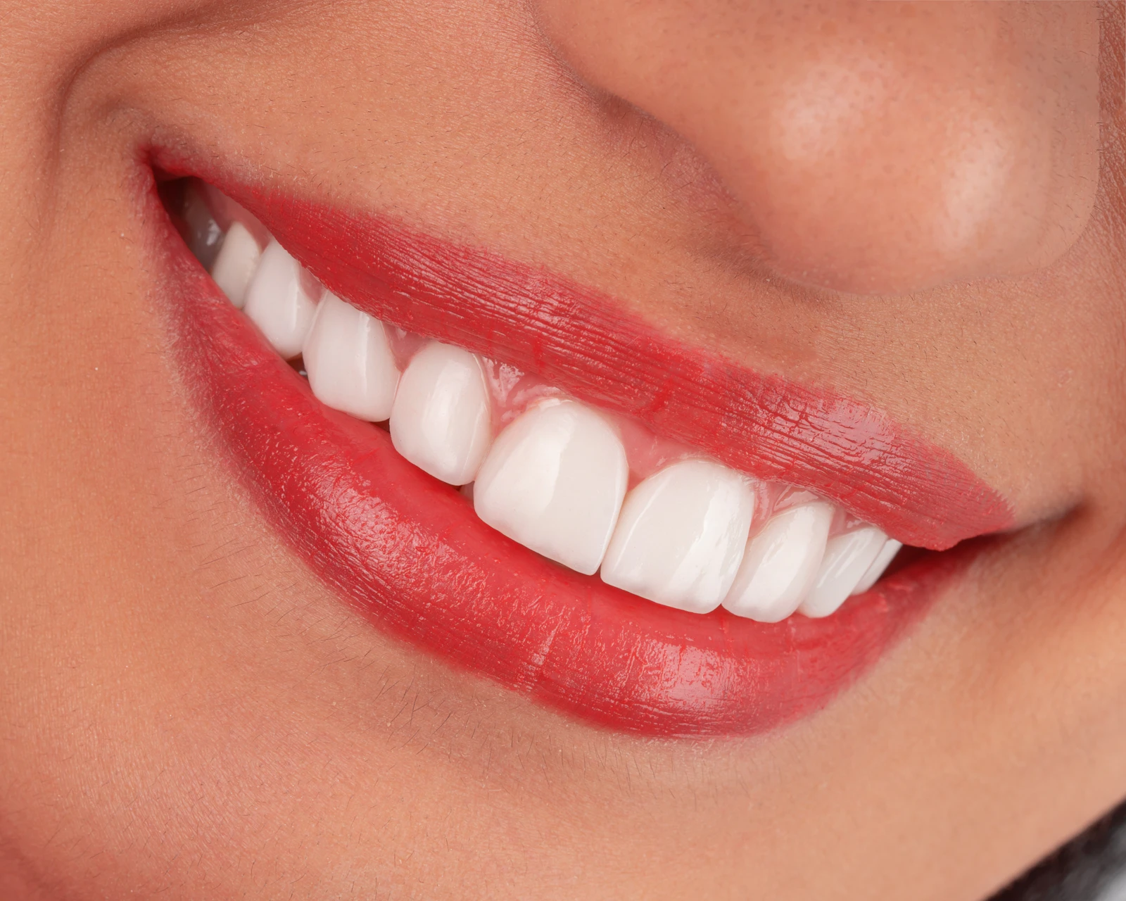 Bright natural smile after composite dental work at UrgentCare Dental