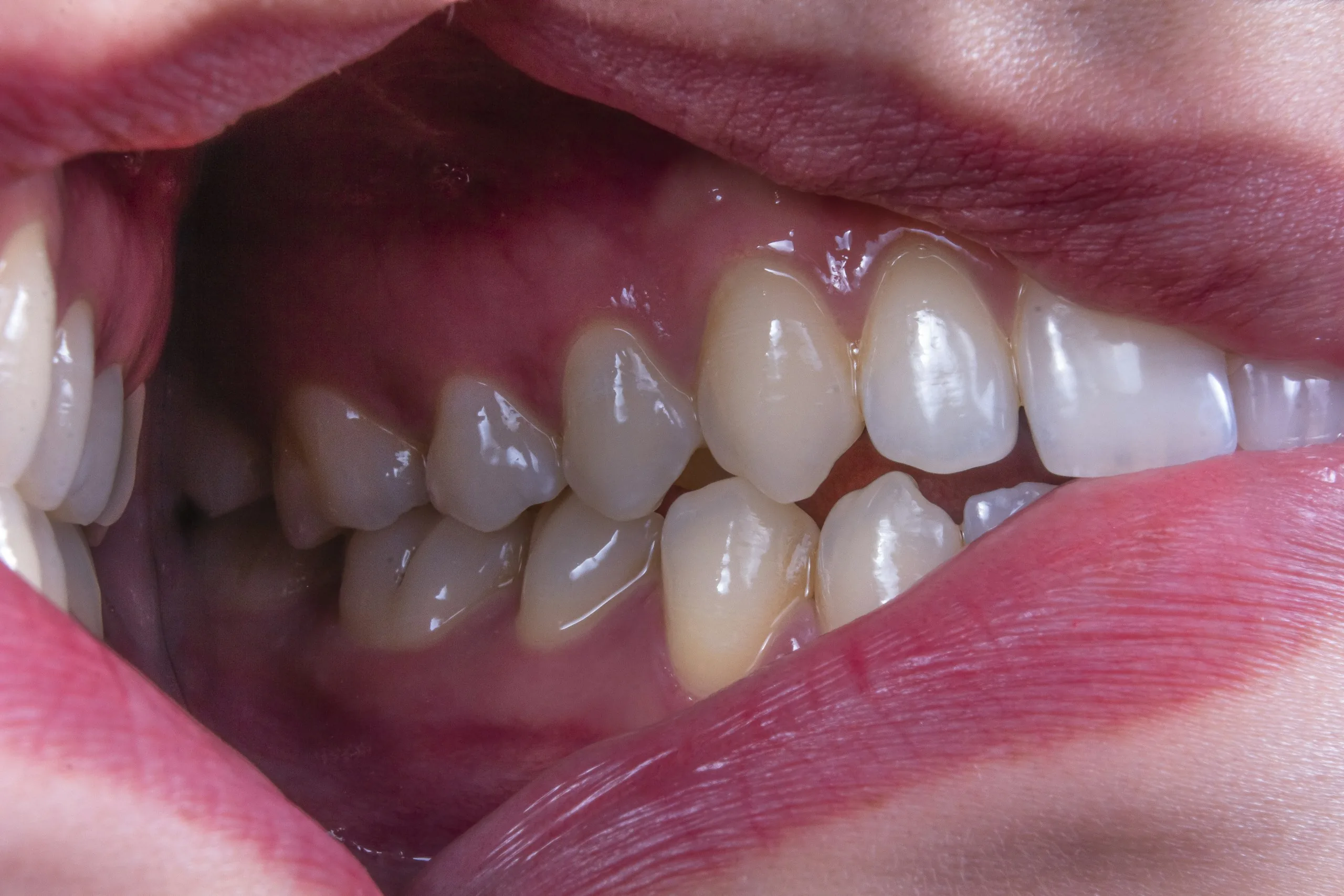 Root canal treatment at UrgentCare Dental