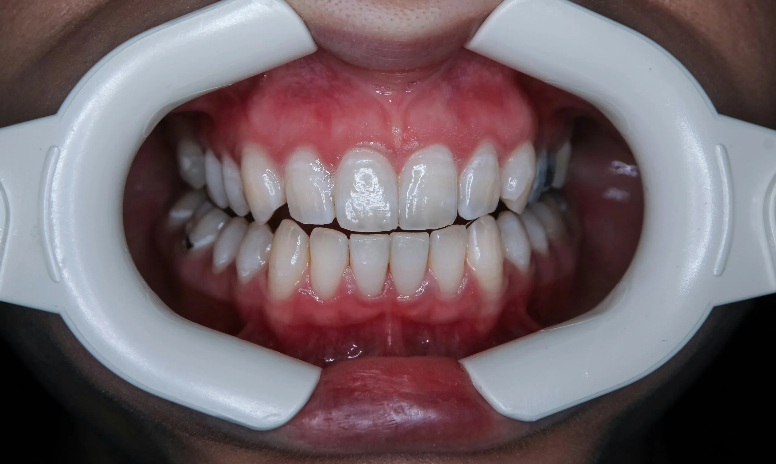 Teeth whitening at UrgentCare Dental